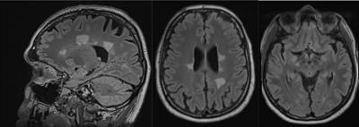 Probable Autoimmune Depression in a Patient With Multiple Sclerosis and Antineuronal Antibodies